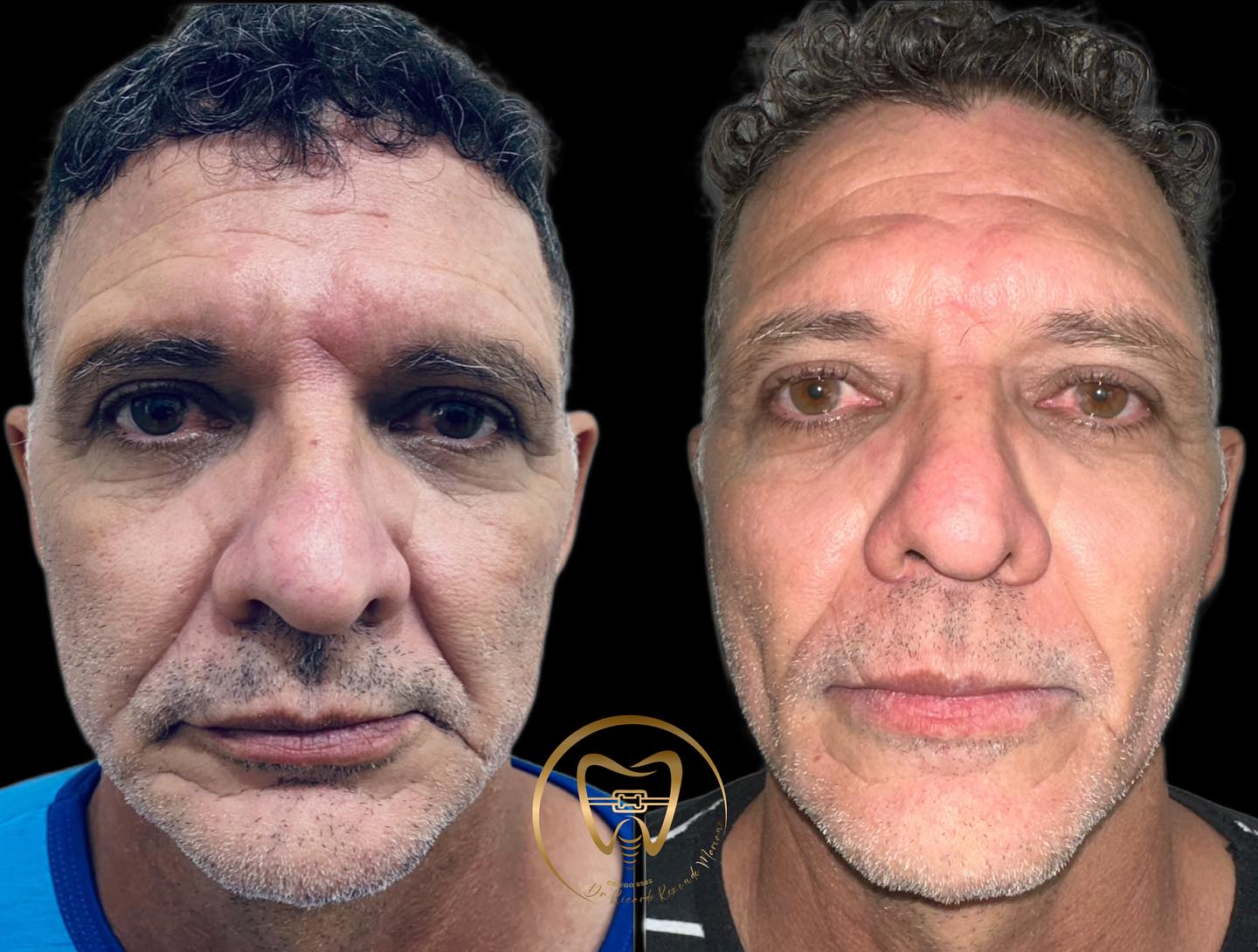 Resultado real de paciente — antes e depois de reabilitação oral, vista frontal