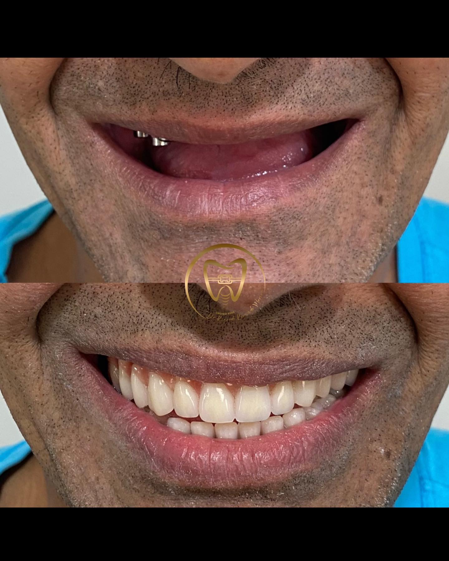 Resultado real de paciente — antes e depois do sorriso inferior