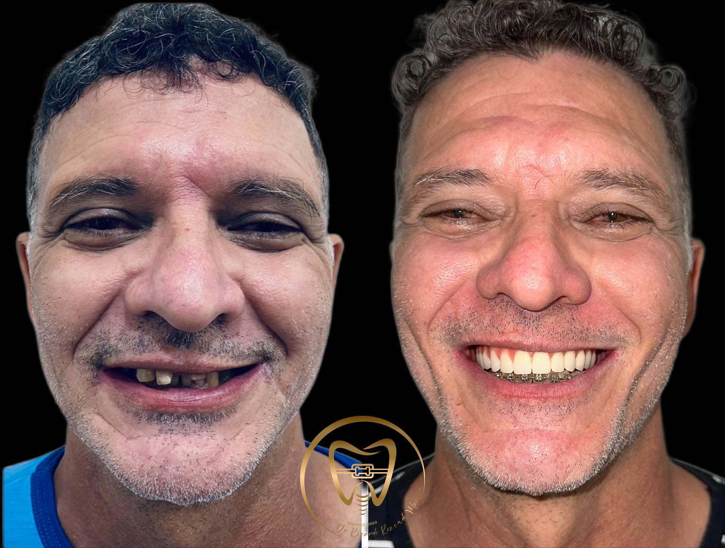 Resultado real de paciente — antes e depois do sorriso